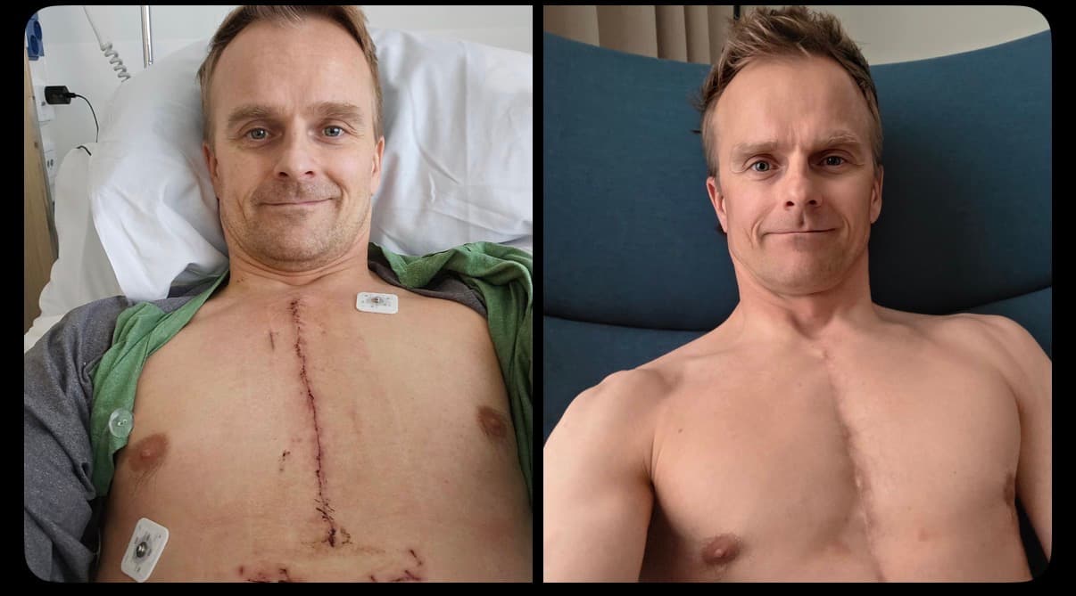 Pilote F1 montrant sa cicatrice d'opération cardiaque avant et après guérison